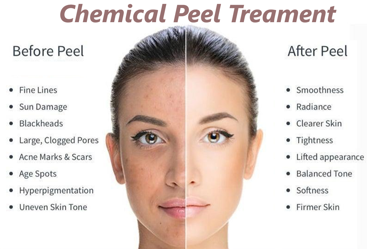 Chemical Peels