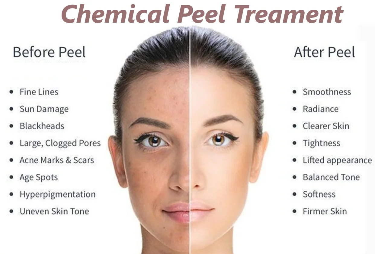 Chemical Peels