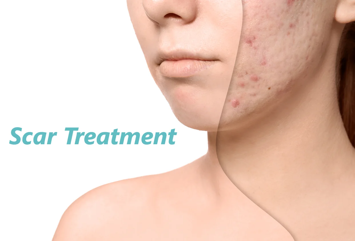 Scar Treatment