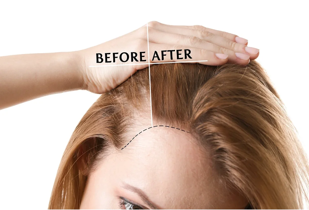 Hair Transplantation