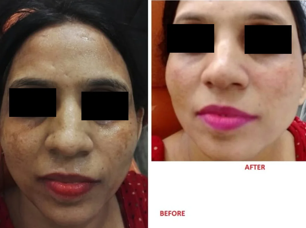 Melasma Treatment
