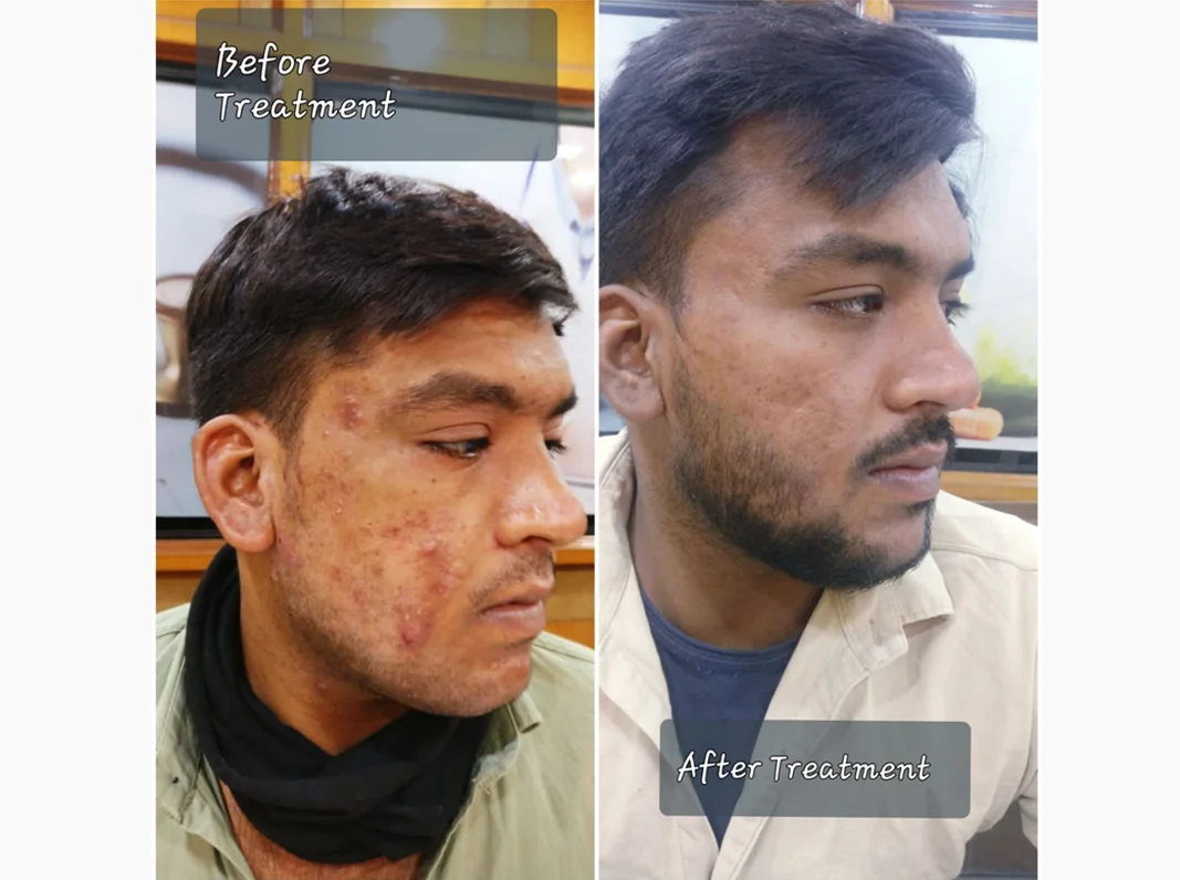 Acne Mark Treatment