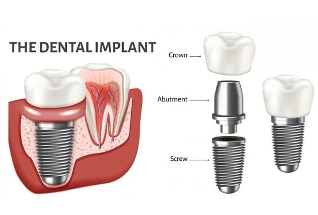 Implants