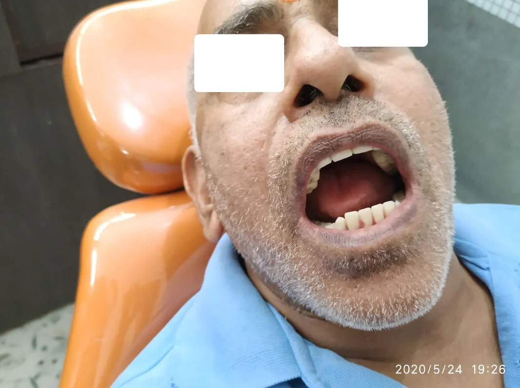Full Mouth Rehabilitation