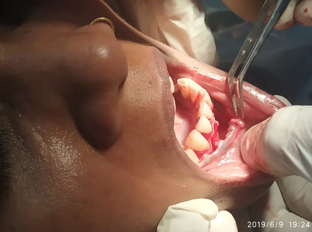 Cyst Removal