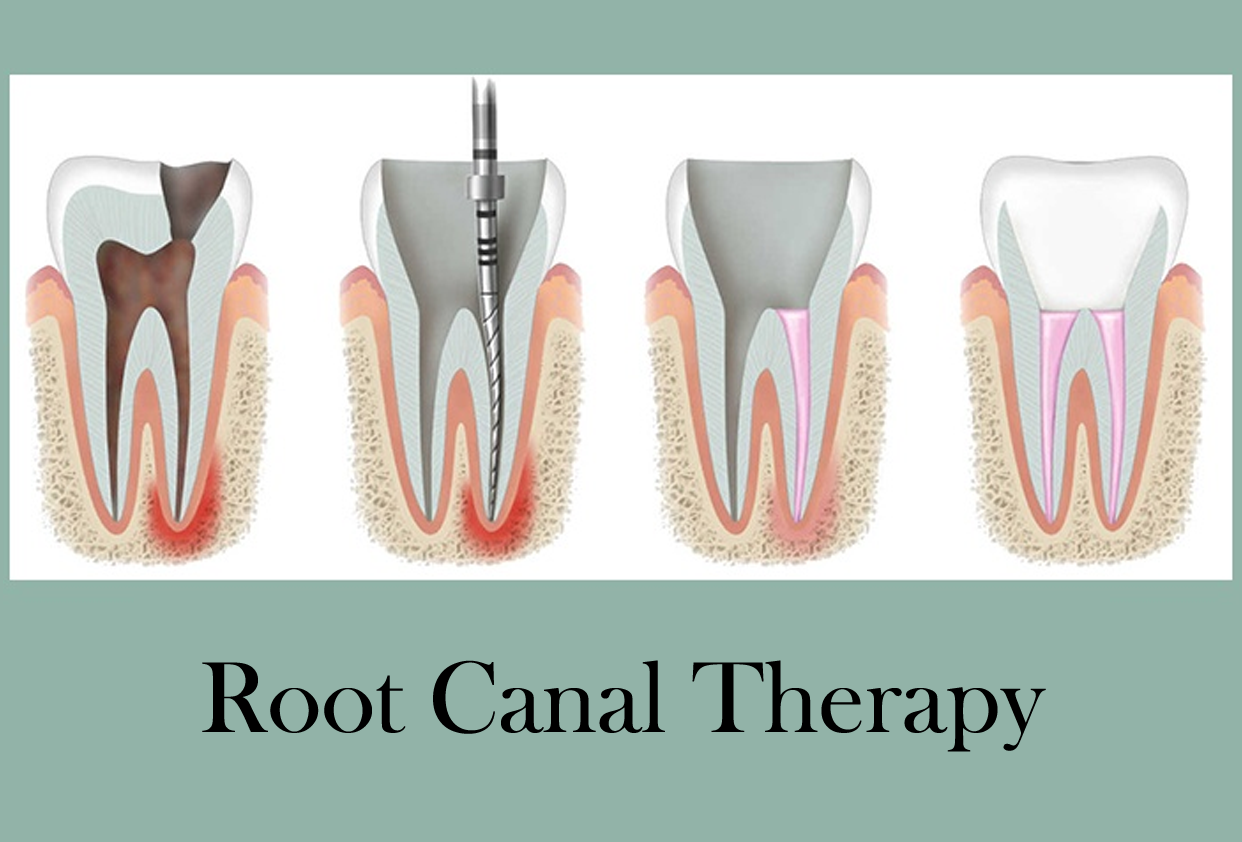 Root Canal Therapy