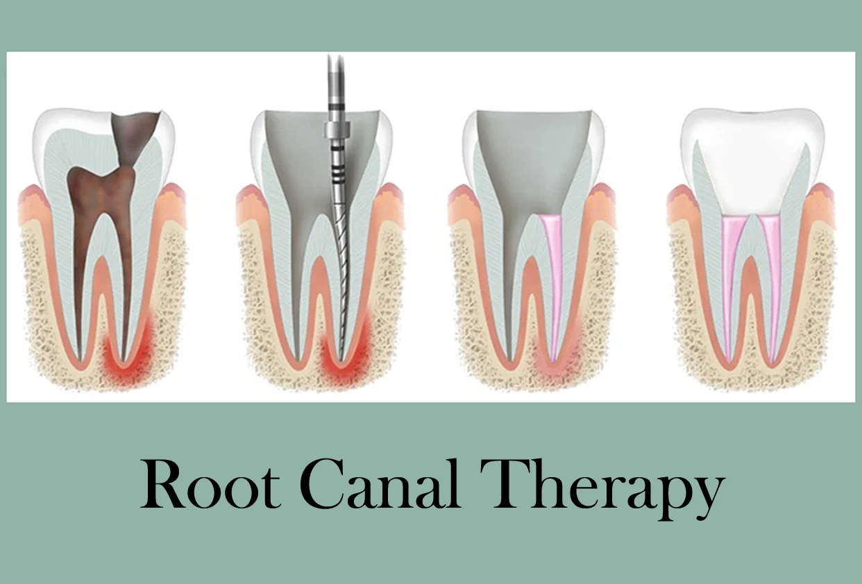 Root Canal Therapy