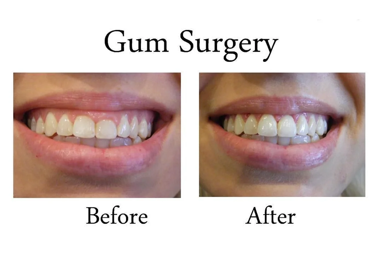 Gum Surgery